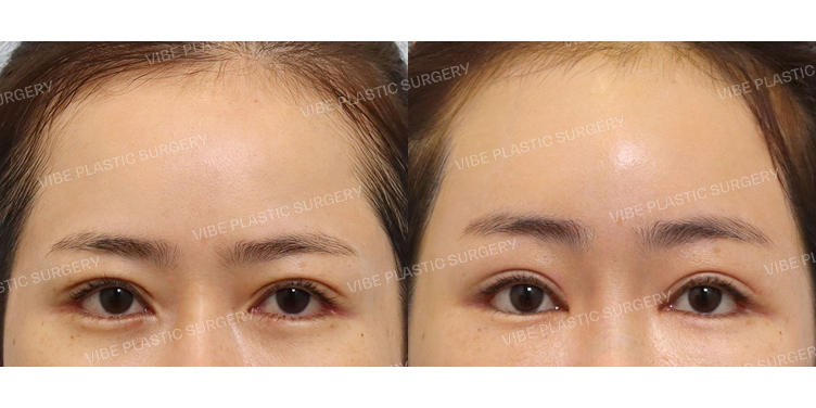 #내시경이마거상