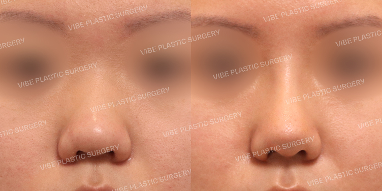 #복코 #비주교정