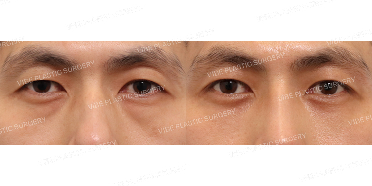 #비절개눈매교정 #눈밑지방재배치