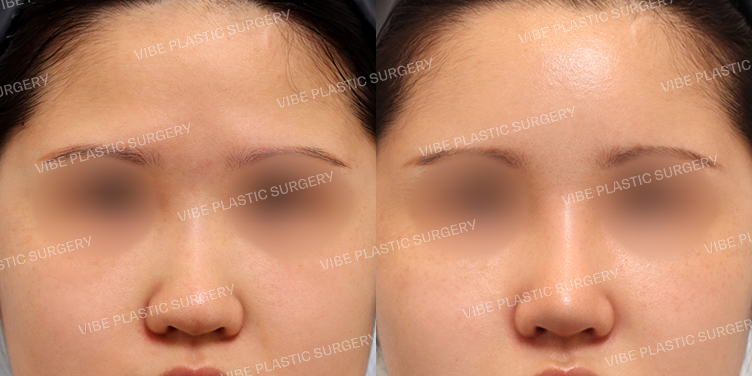 #이물질제거 #콧대 #복코 #지방이식(이마,관자)