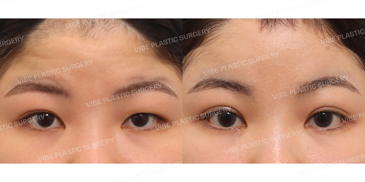 #내시경이마거상 #부분절개눈매교정