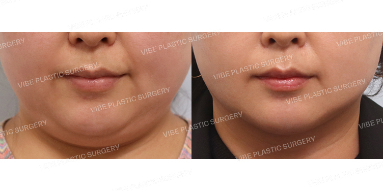 #초음파지방흡입(이중턱,턱라인)