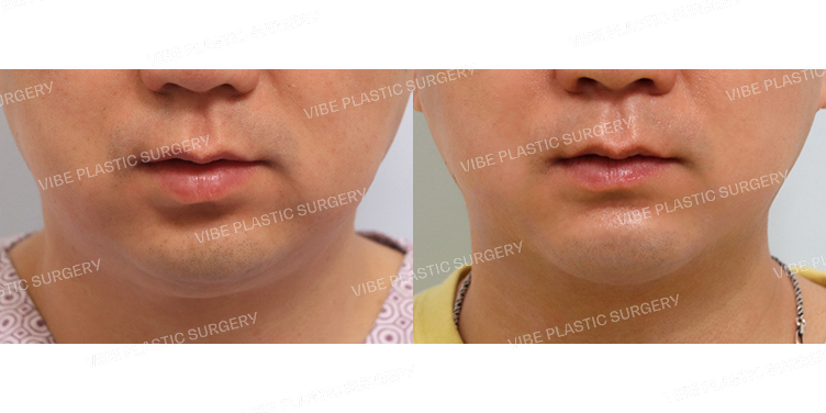 #초음파지방흡입(이중턱,턱라인)