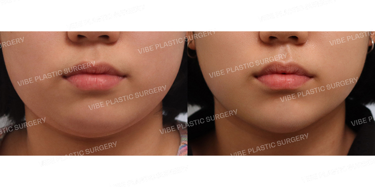 #초음파지방흡입(이중턱,턱라인) #턱끝필러