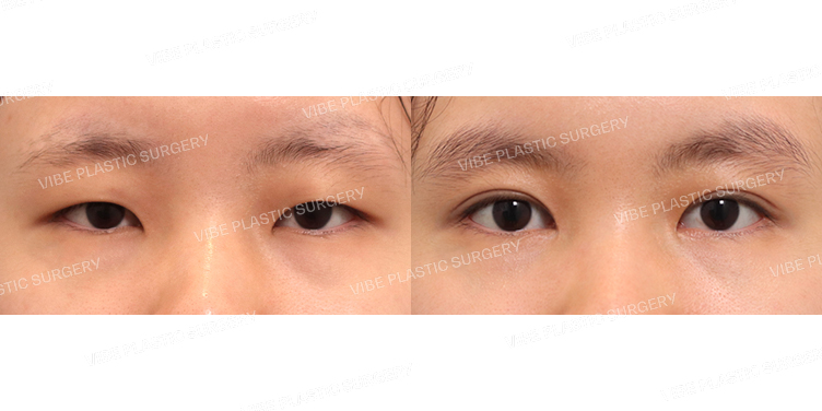 #부분절개눈매교정 #앞트임