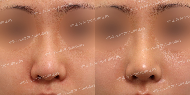 #무보형물 #복코