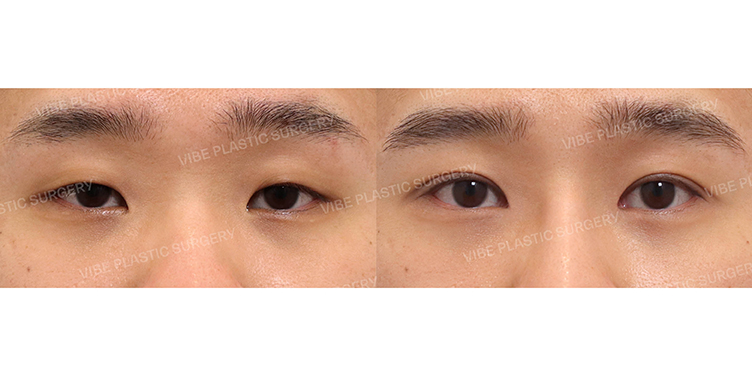 #비절개눈매교정 #앞트임