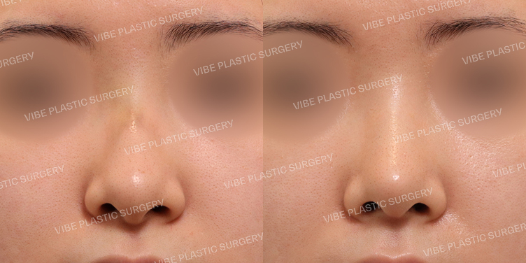 #무보형물 #매부리코 #복코 #긴코