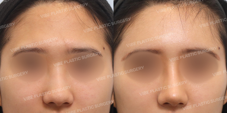 #매부리코 #긴코 #이마지방이식