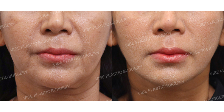 #절개안면거상 #목거상(이중턱근육묶기)