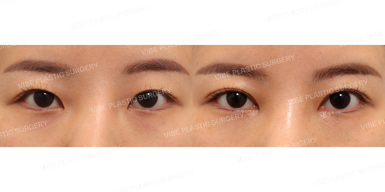 #절개쌍꺼풀(재수술) #윗트임