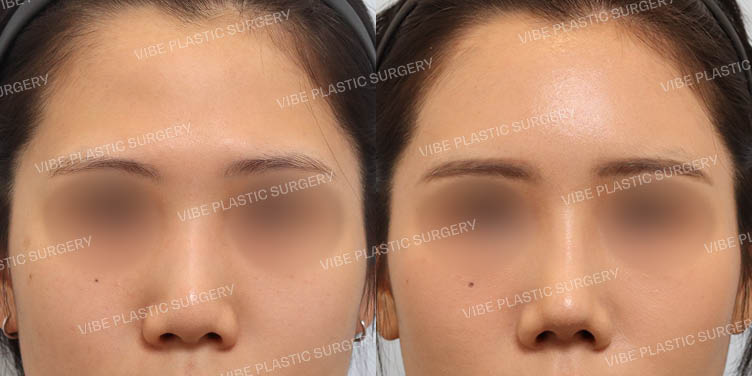 #이마지방이식 #복코 #짧은코