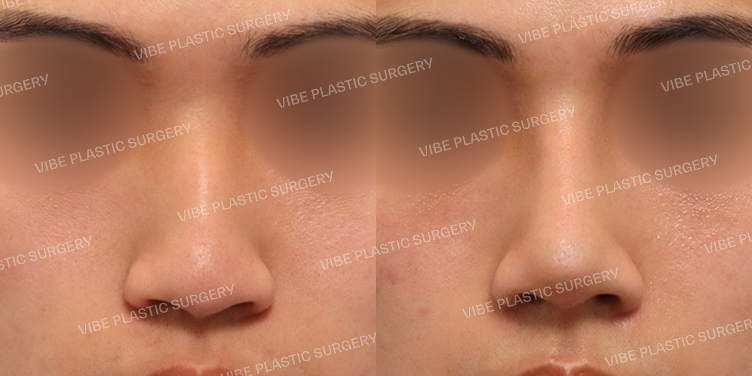 #매부리코 #휜코