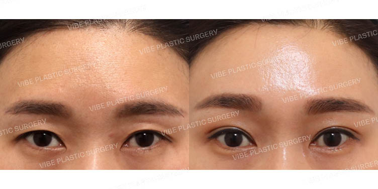 #자연유착 #내시경이마거상