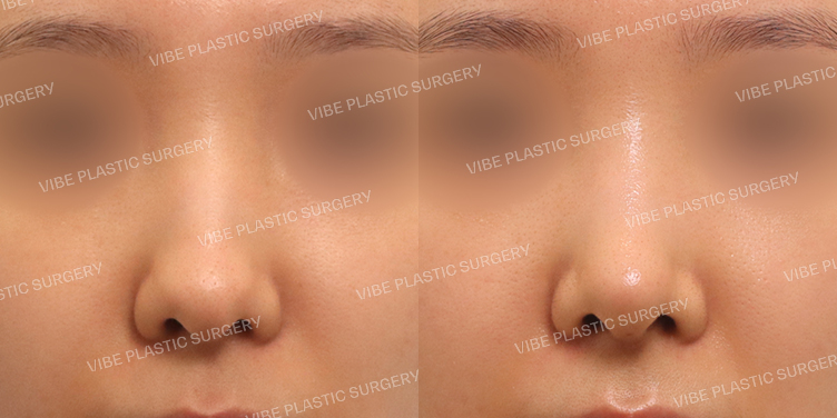 #무보형물 #매부리코 #긴코