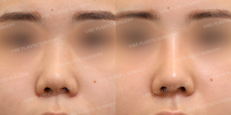 #복코 #짧은코 #매부리코 #비순각성형