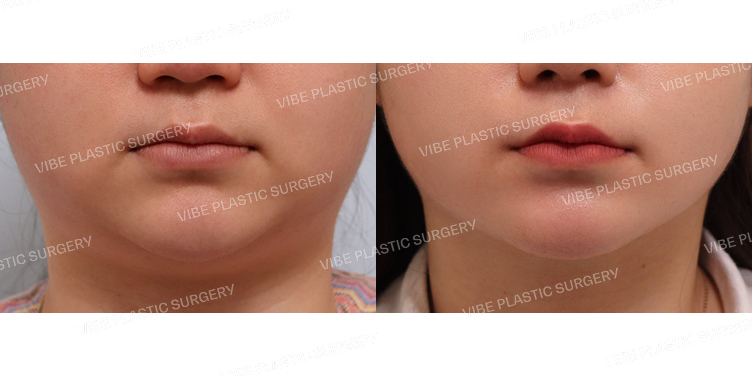 #초음파지방흡입(이중턱,턱라인)