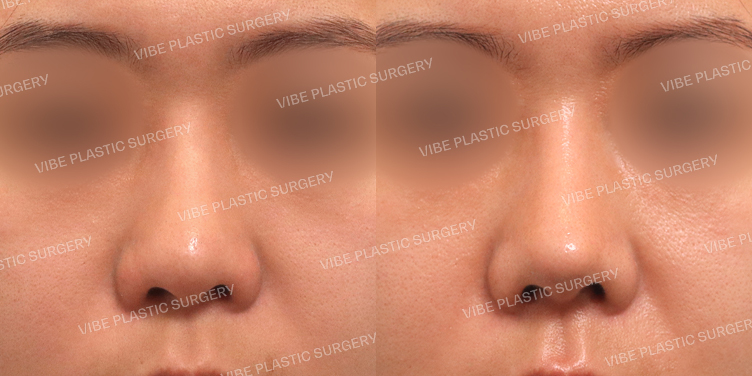 #복코 #재수술(L-보형물교체)