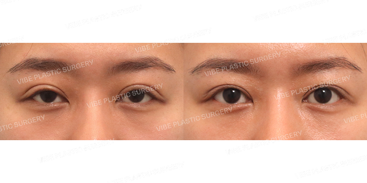 #절개눈매교정(4번째재수술)