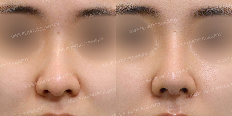 #매부리코 #휜코 #복코 #긴코 #비순각교정 #기능코