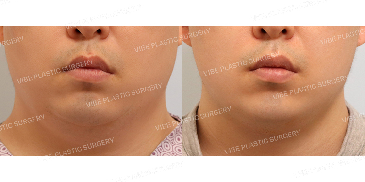 #실리프팅 #초음파지방흡입(이중턱,턱라인)