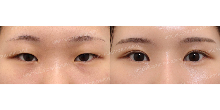 #절개쌍꺼풀 #앞트임 #윗트임