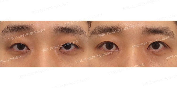 #비절개눈매교정 #앞트임