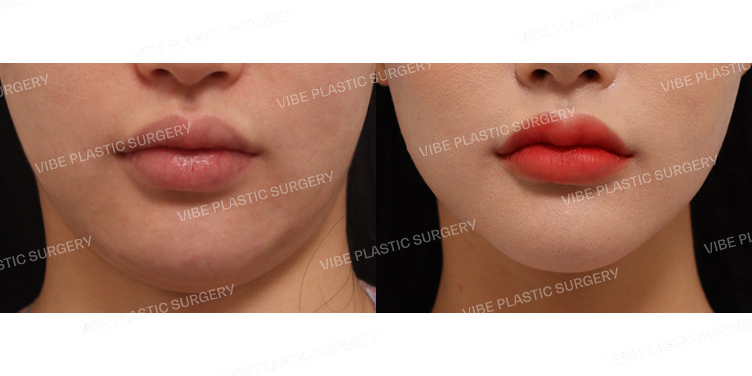 #실리프팅 #초음파지방흡입(이중턱,턱라인)