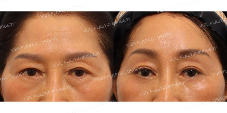 #하안검(재수술) #내시경이마거상