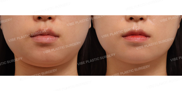 #초음파지방흡입(이중턱,턱라인)