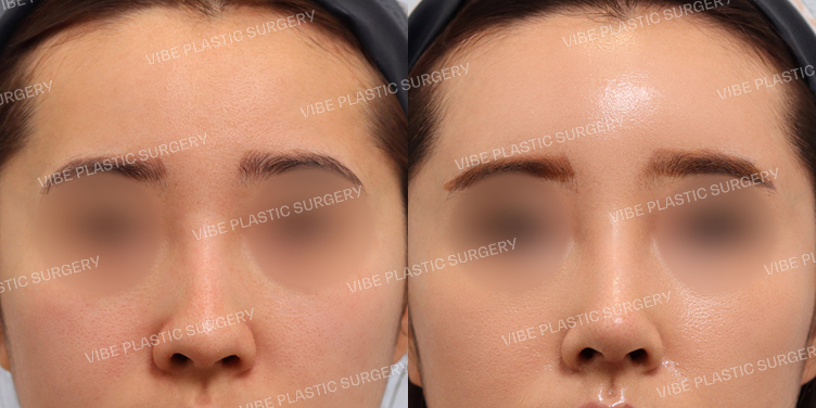 #이마지방이식 #무보형물 #매부리코 #긴코