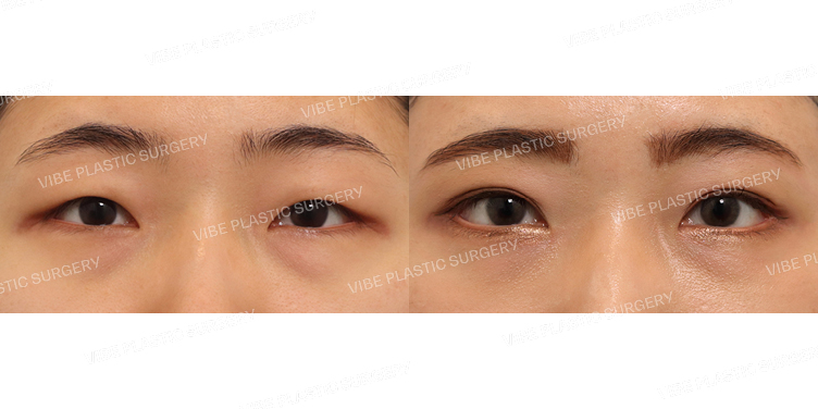 #절개눈매교정 #눈밑지방재배치 #뒤트임 #밑트임