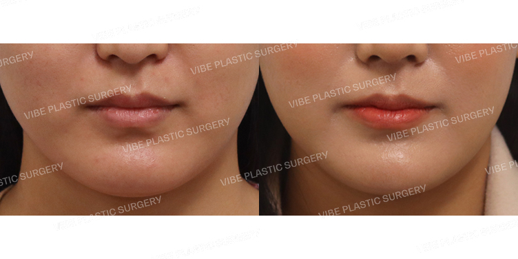 #초음파지방흡입(이중턱&턱라인) #심부볼지방제거