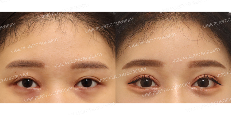 #내시경이마거상 #절개쌍꺼풀(재수술) #뒤트임 #밑트임