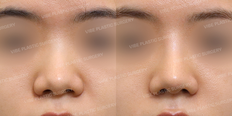 #코끝 #복코 #필러녹이기 #실리콘보형물 #콧볼축소