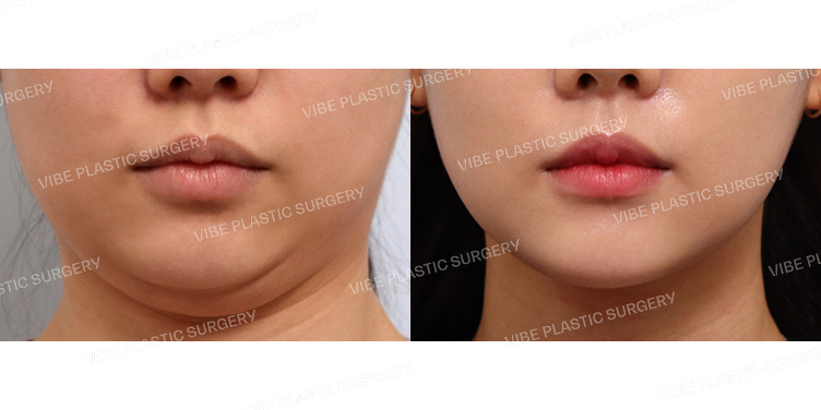 #초음파지방흡입(이중턱)