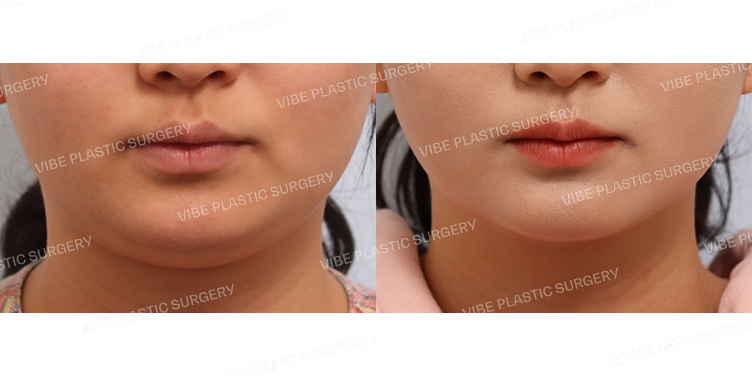#초음파지방흡입(이중턱,턱라인)