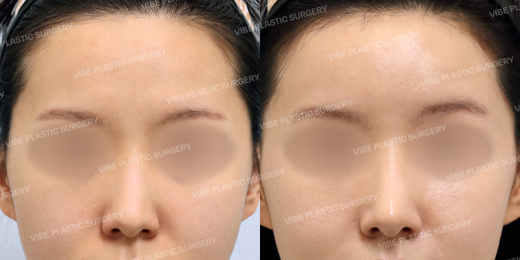 #풀페이스지방이식 #콧대 #코끝 #매부리코 #긴코