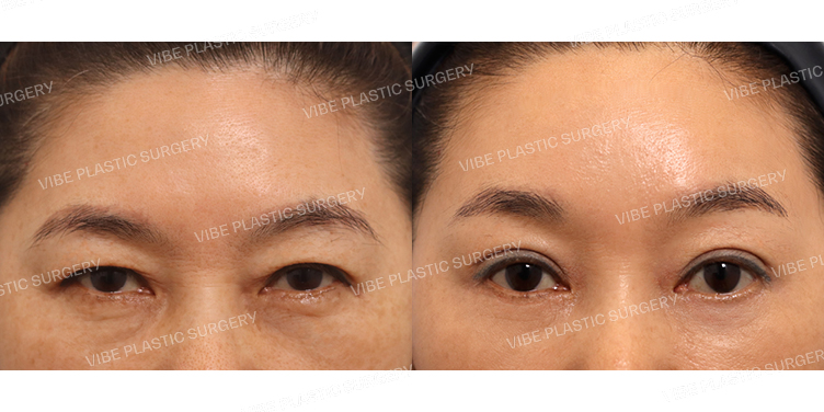 #비절개눈매교정 #하안검 #내시경이마거상