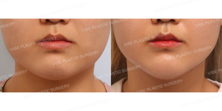 #초음파지방흡입(이중턱,턱라인)