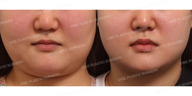 #리포사운드지방흡입(턱라인,이중턱,앞볼)