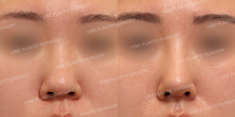 #복코 #비주교정 #이물질제거