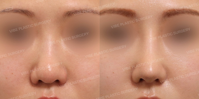 #콧대 #복코 #비순각성형 #비중격연장이식