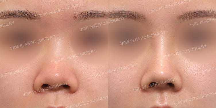 #복코 #짧은코 #콧대 #비절개콧볼축소