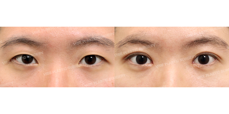 #매몰쌍꺼풀 #앞트임