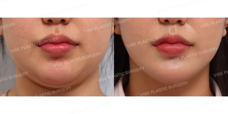 #초음파지방흡입(이중턱,턱라인)