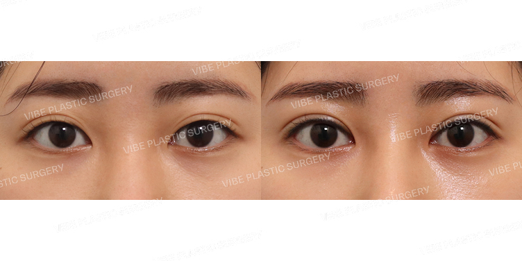 #절개쌍꺼풀(재수술)