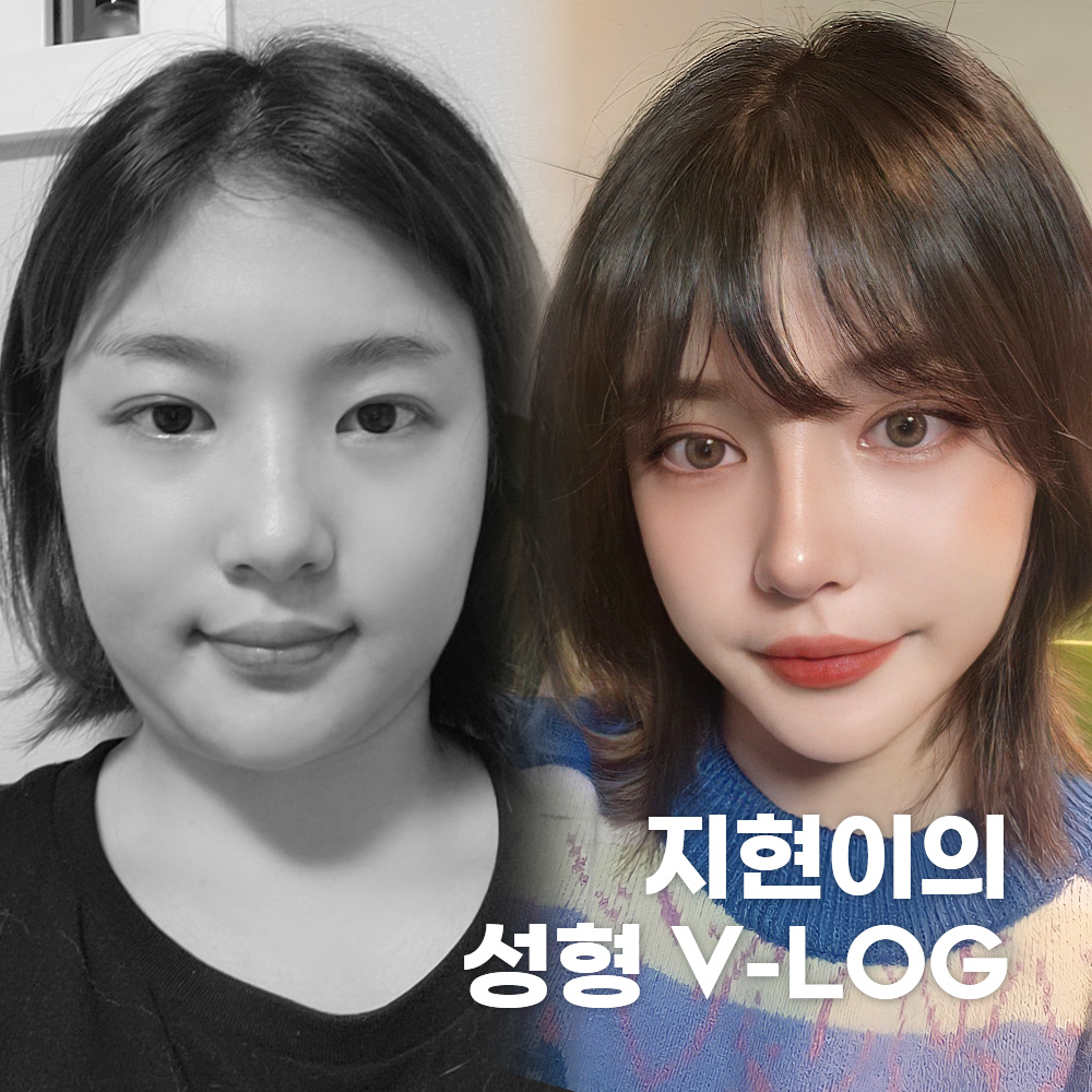 지현이의 성형 V-LOG