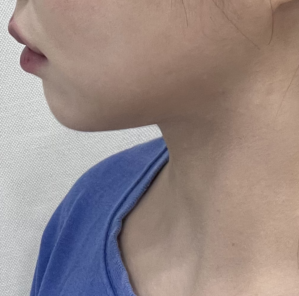 투턱이 없어졌어용 ㅎㅎ