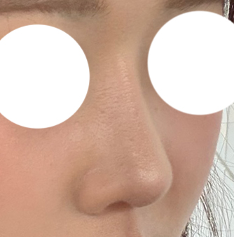 첫코, 눈재수술 3개월차 후기입니다!